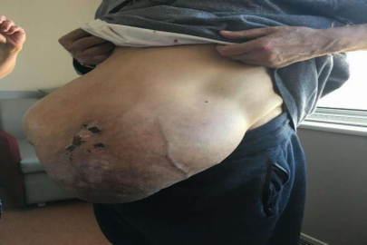 Fransa’da karnı her gün büyüyordu çareyi Türkiye’de buldu