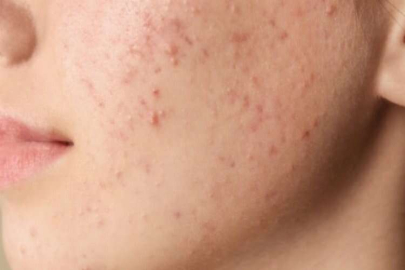 AKNE SORUNUNU TETİKLEYEN BESİNLERE DİKKAT !