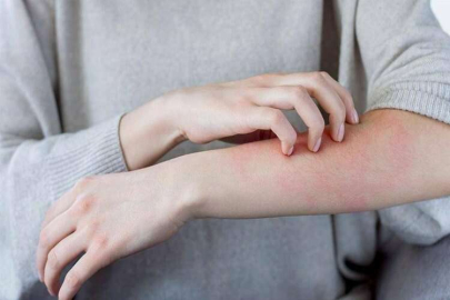 Korkutan “uyuz” açıklaması: “5 yıldızlı otellerden bile gelen hastalar var”