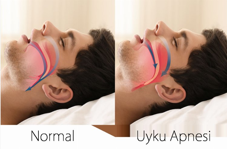 uyku apnesi 