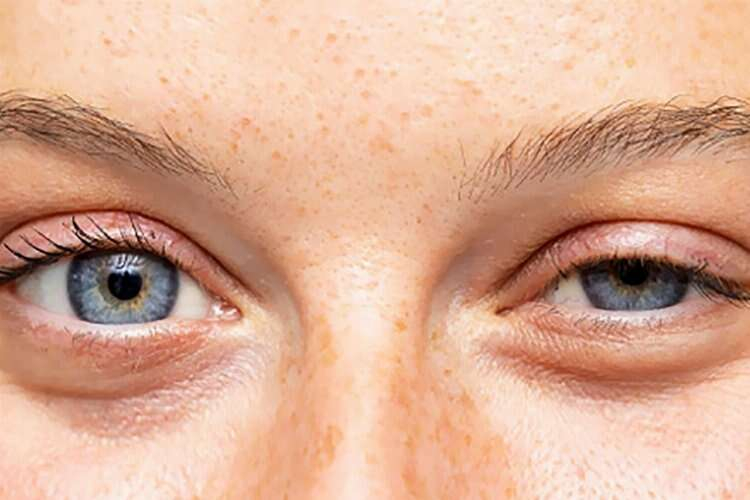 Ünlülerin Göz Doktoru Op. Dr. Tuncay Sezgin Düşük göz kapağı kaderiniz değil! 2