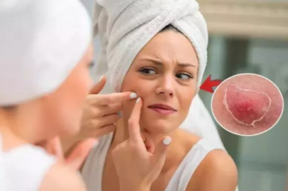 Bunu öğrendikten sonra bir daha sivilcenize dokunmayacaksınız! Bilseniz hiç yapmazdınız