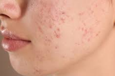 Doç. Dr. Gürol Açıkgöz: Akneye sebep olan faktörler hakkında bilgilendirmelerde bulundu 