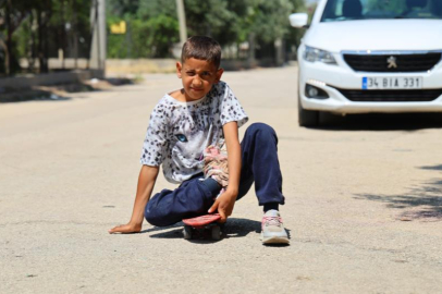 Kaza sonrası ayağı yanlış kaynadı, hayatı kaykay üzerinde geçiyor