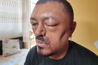 Saç siyahlaştırıcı şampuan kabusu: Berberin tavsiyesiyle aldı, arı sokmasından beter hale döndü!