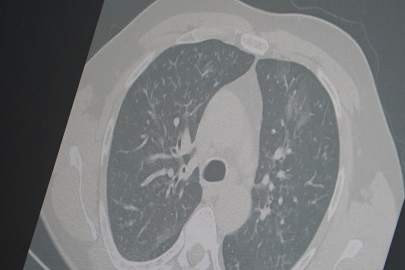 Uzmanlardan “3’lü salgın” uyarısı: “Frankenstein varyantı yayılıyor”