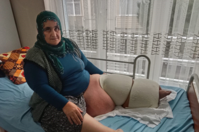 35 yıldır 'fil hastalığı' ile savaşıyor: Hastalığı bacağını 100 kilo yaptı, tedavisinin devamı için destek bekliyor
