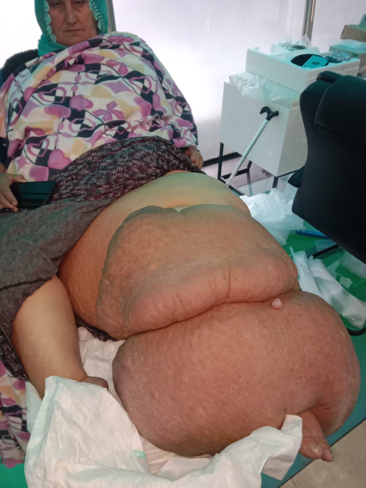 35 yıldır 'fil hastalığı' ile savaşıyor Hastalığı bacağını 100 kilo yaptı, tedavisinin devamı için destek bekliyor 2