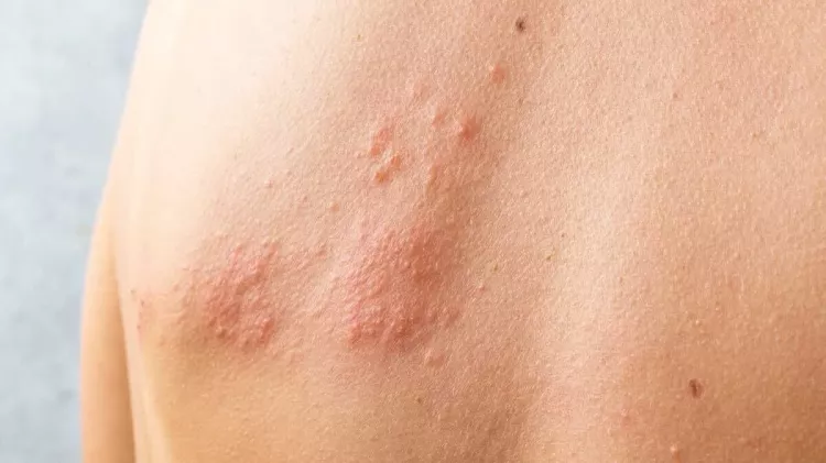 Zona hastalığı nedir, belirtileri ve tedavi yöntemleri neler 2