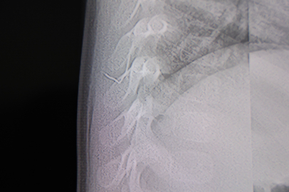 Kahramanmaraş’ta 1 yaşındaki bebeğin sırtından zımba teli çıkarıldı