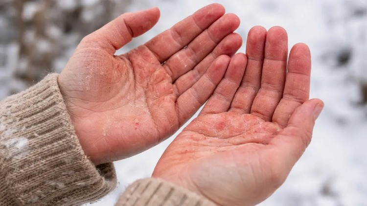 Soyulan tırnakların sebebi