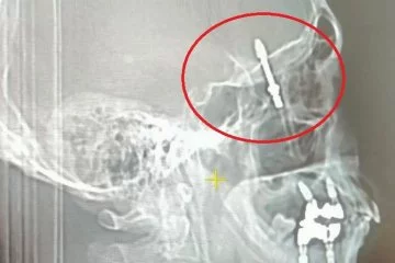 Bursa'da implant tedavisi sırasında vida çene kemiğini delip beyne saplandı