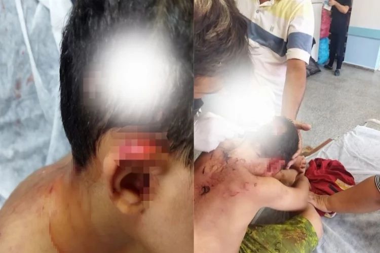 Köpeğin saldırısına uğrayan çocuğun kafasında derin yaralar oluştu